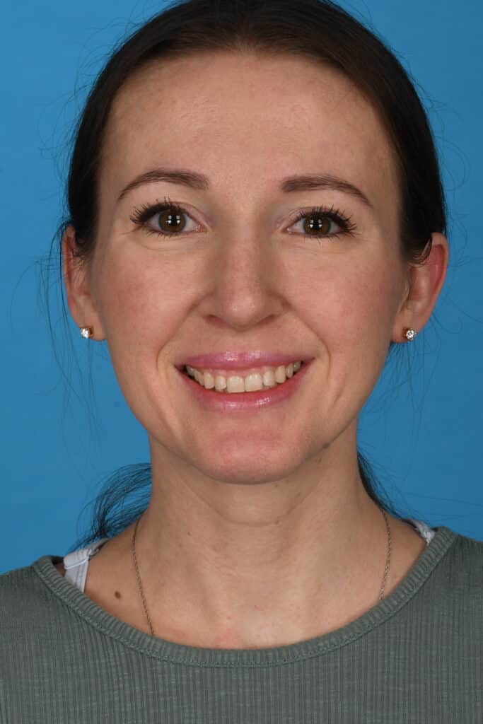 After Image: Rhinoplasty with chin augmentation - front