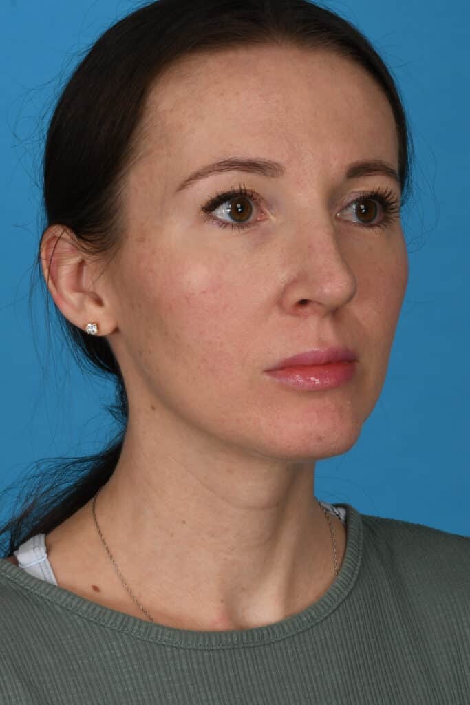 After Image: Rhinoplasty with chin augmentation - right-front-oblique
