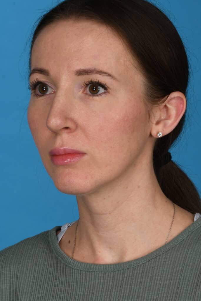 After Image: Rhinoplasty with chin augmentation - left-front-oblique