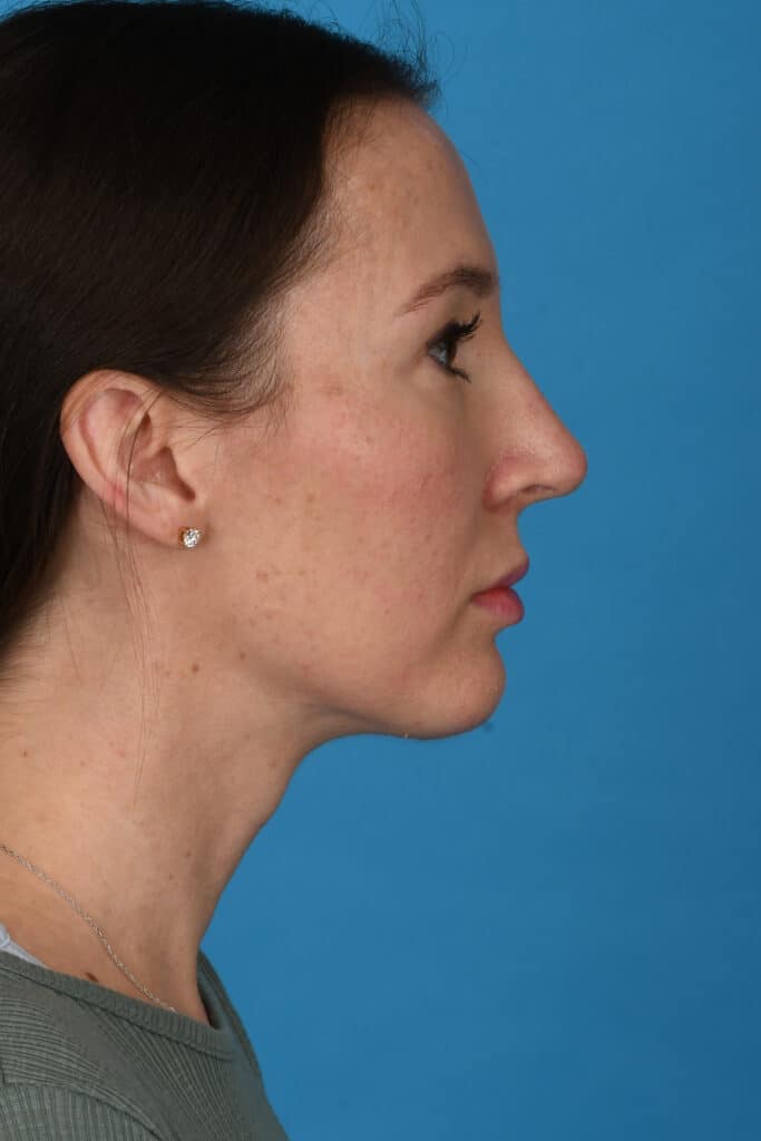 After Image: Rhinoplasty with chin augmentation - right-side
