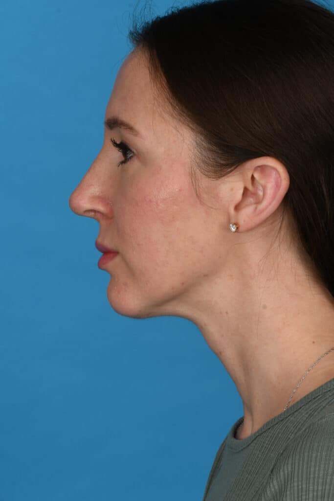 After Image: Rhinoplasty with chin augmentation - left-side