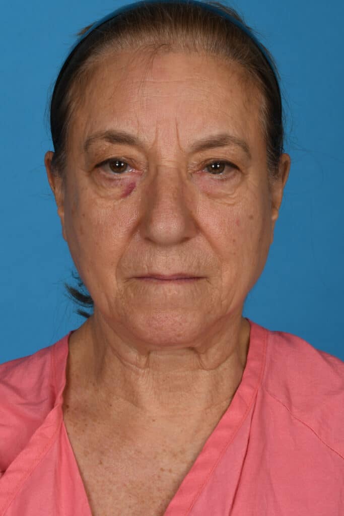 Before Image: Upper and lower blepharoplasty, selective fat grafting to face, laser resurfacing - front