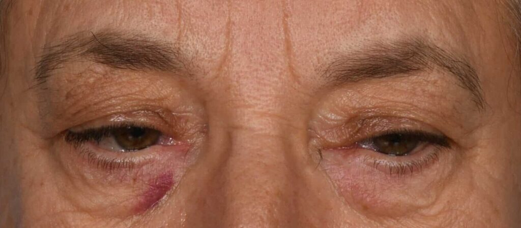 Before Image: Upper and lower blepharoplasty, selective fat grafting to face, laser resurfacing - front