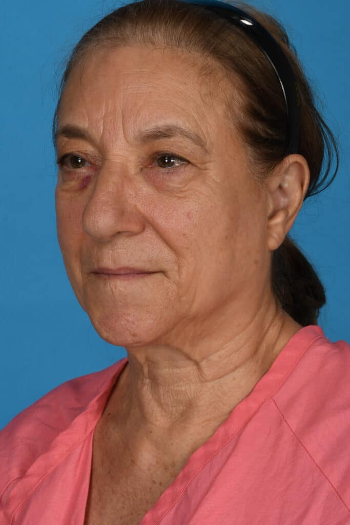 Before Image: Upper and lower blepharoplasty, selective fat grafting to face, laser resurfacing - left-front-oblique