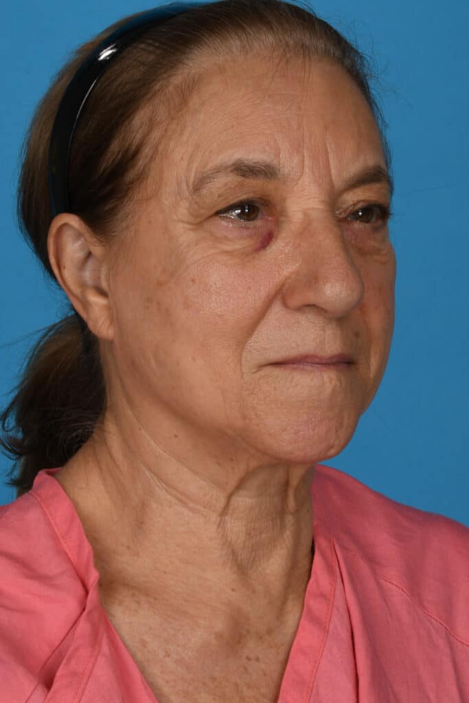Before Image: Upper and lower blepharoplasty, selective fat grafting to face, laser resurfacing - right-front-oblique