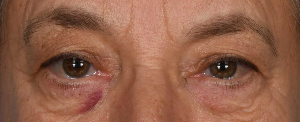 Before Image: Upper and lower blepharoplasty, selective fat grafting to face, laser resurfacing - front