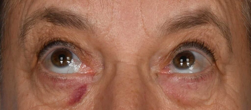 Before Image: Upper and lower blepharoplasty, selective fat grafting to face, laser resurfacing - front