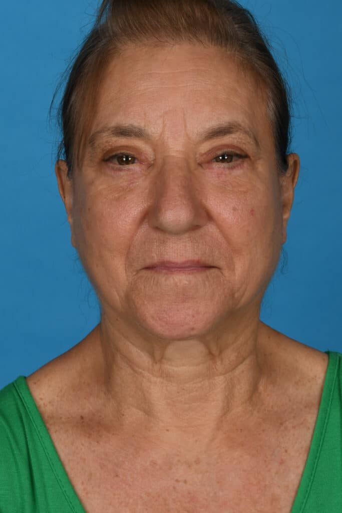 After Image: Upper and lower blepharoplasty, selective fat grafting to face, laser resurfacing - front