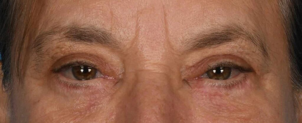 After Image: Upper and lower blepharoplasty, selective fat grafting to face, laser resurfacing - front