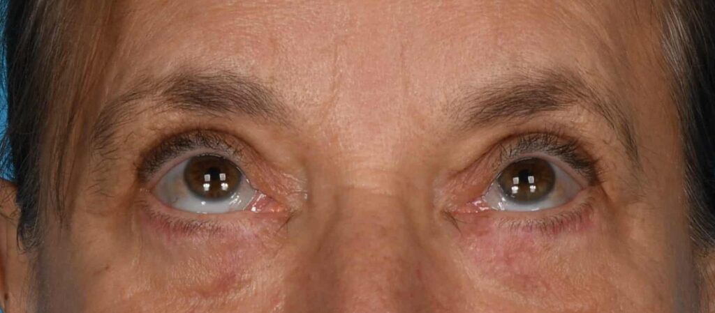 After Image: Upper and lower blepharoplasty, selective fat grafting to face, laser resurfacing - front