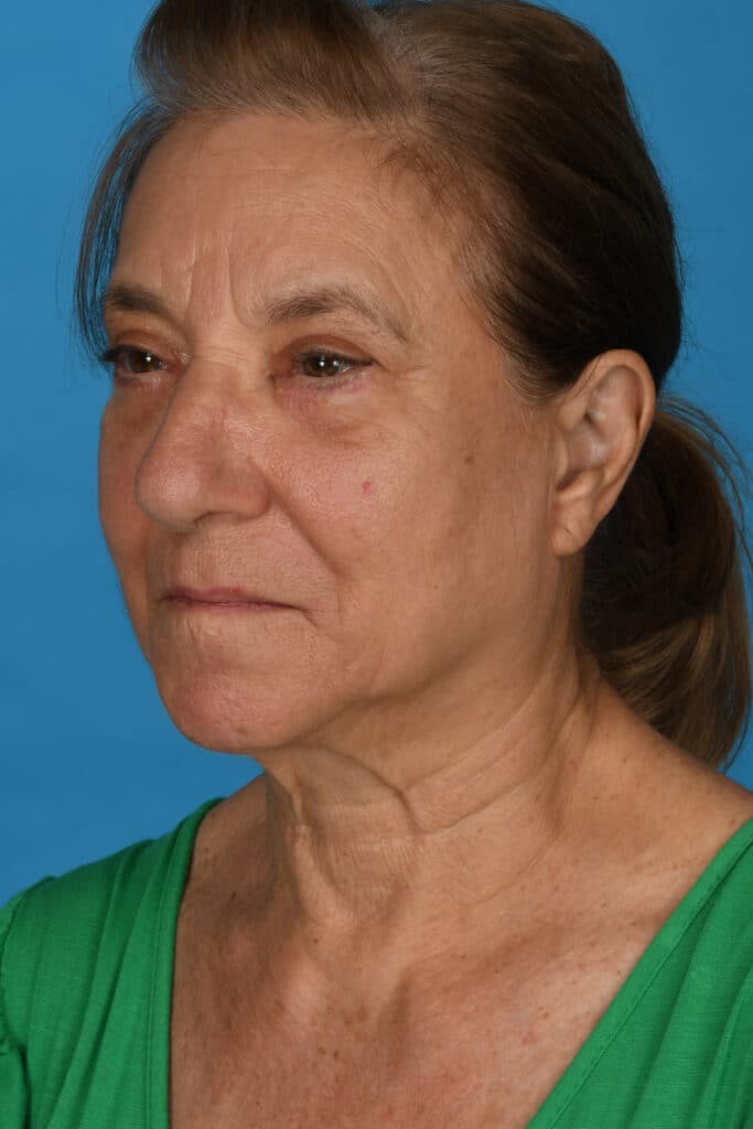 After Image: Upper and lower blepharoplasty, selective fat grafting to face, laser resurfacing - left-front-oblique