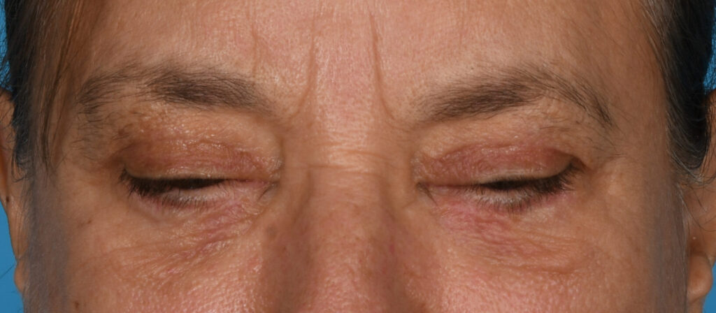 After Image: Upper and lower blepharoplasty, selective fat grafting to face, laser resurfacing - front