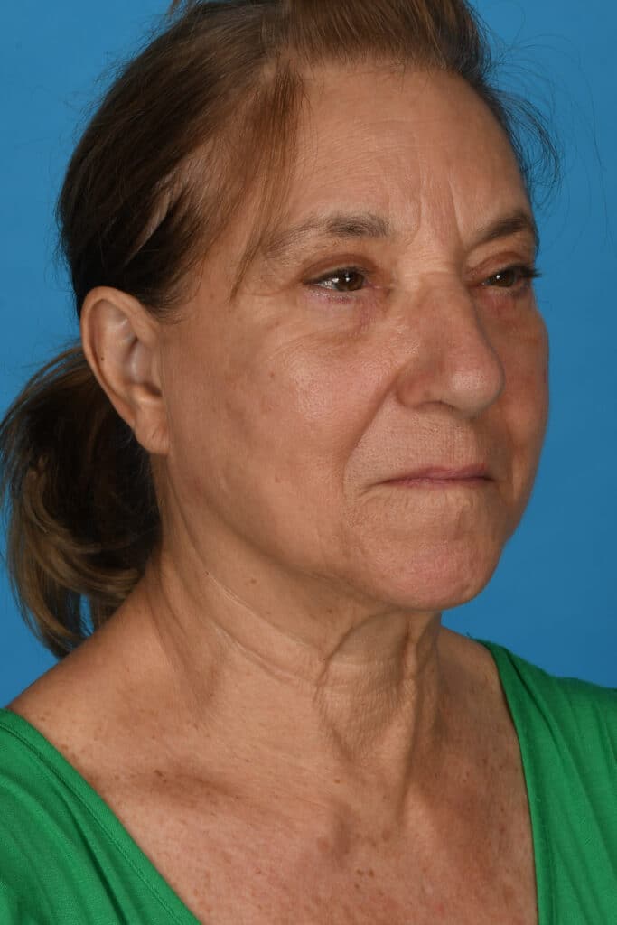 After Image: Upper and lower blepharoplasty, selective fat grafting to face, laser resurfacing - right-front-oblique