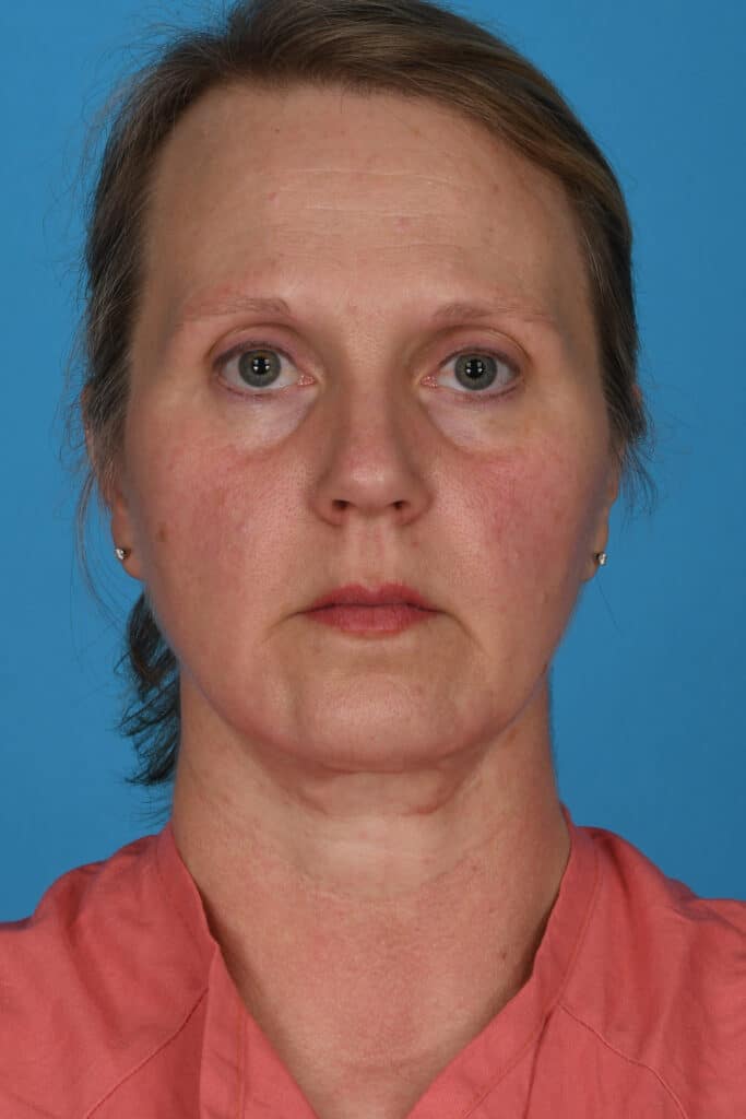Before Image: Facelift, secondary necklift - front