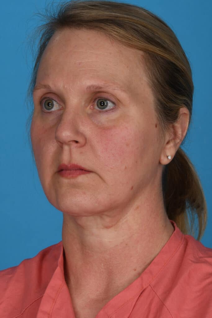 Before Image: Facelift, secondary necklift - left-front-oblique