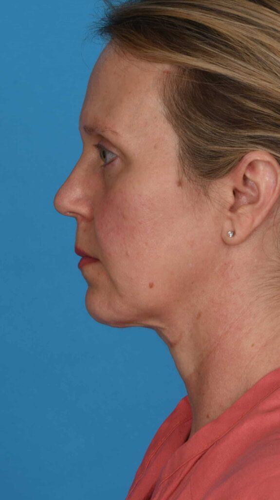 Before Image: Facelift, secondary necklift - left-side