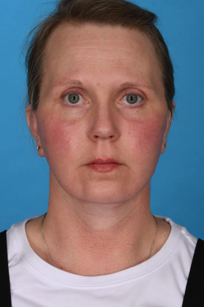 After Image: Facelift, secondary necklift - front