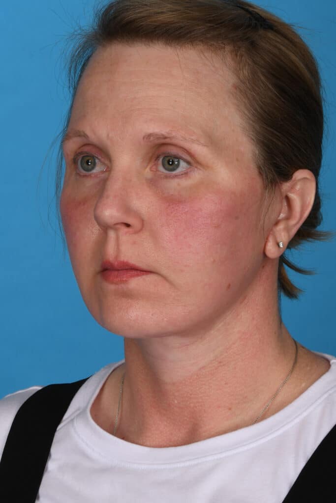 After Image: Facelift, secondary necklift - left-front-oblique