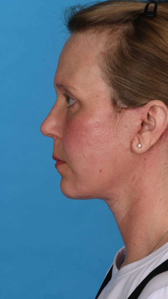 After Image: Facelift, secondary necklift - left-side