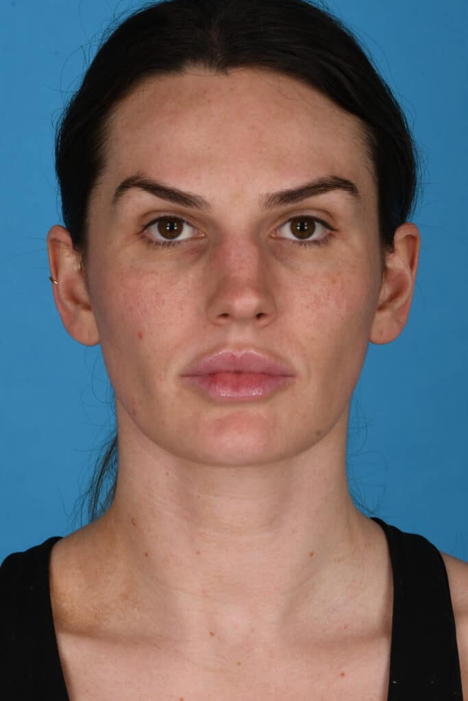 Before Image: Rhinoplasty - front
