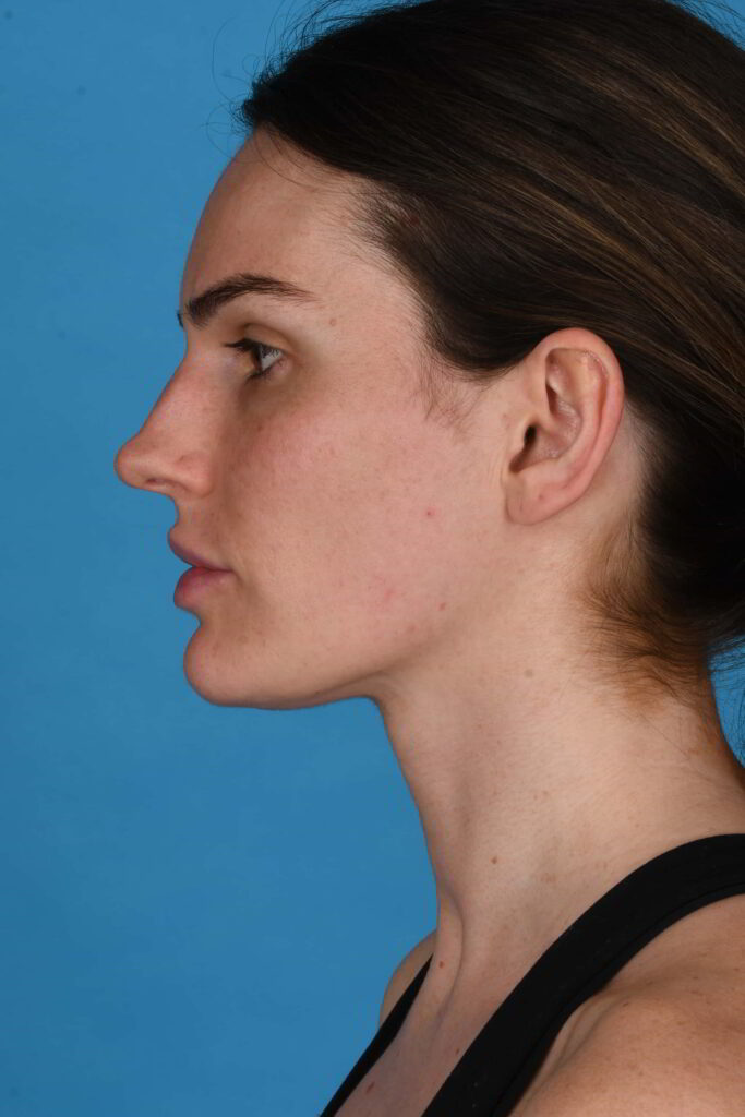 Before Image: Rhinoplasty - left-side