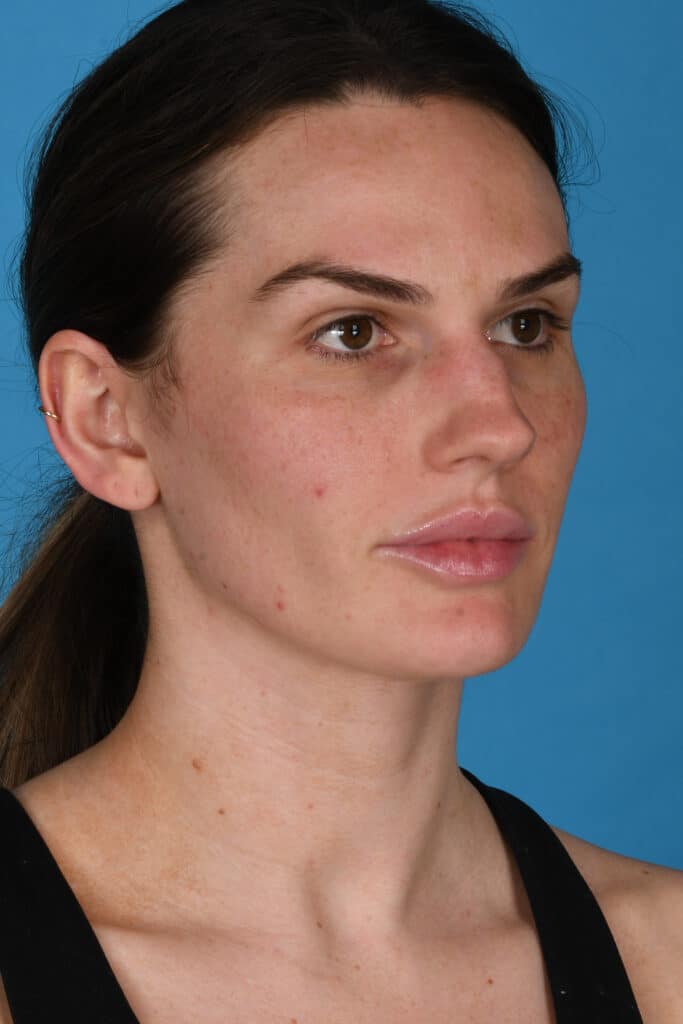 Before Image: Rhinoplasty - right-front-oblique