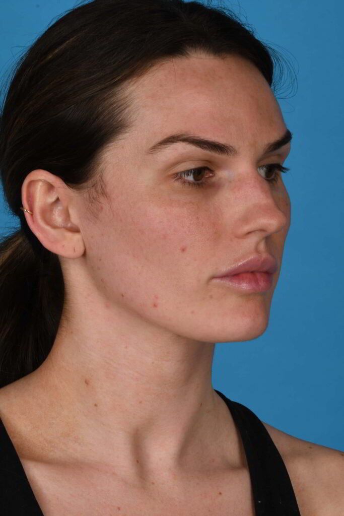 Before Image: Rhinoplasty - right-front-oblique
