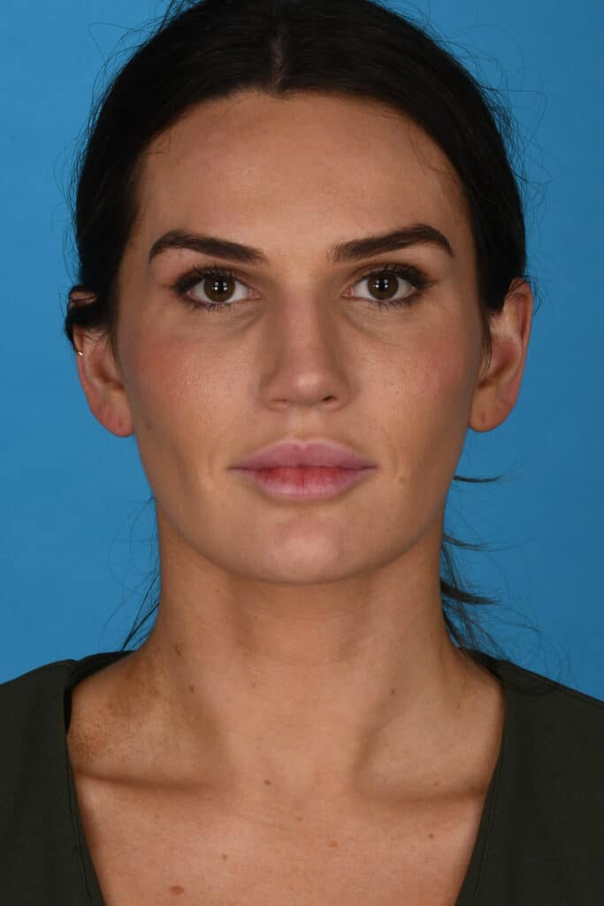 After Image: Rhinoplasty - front