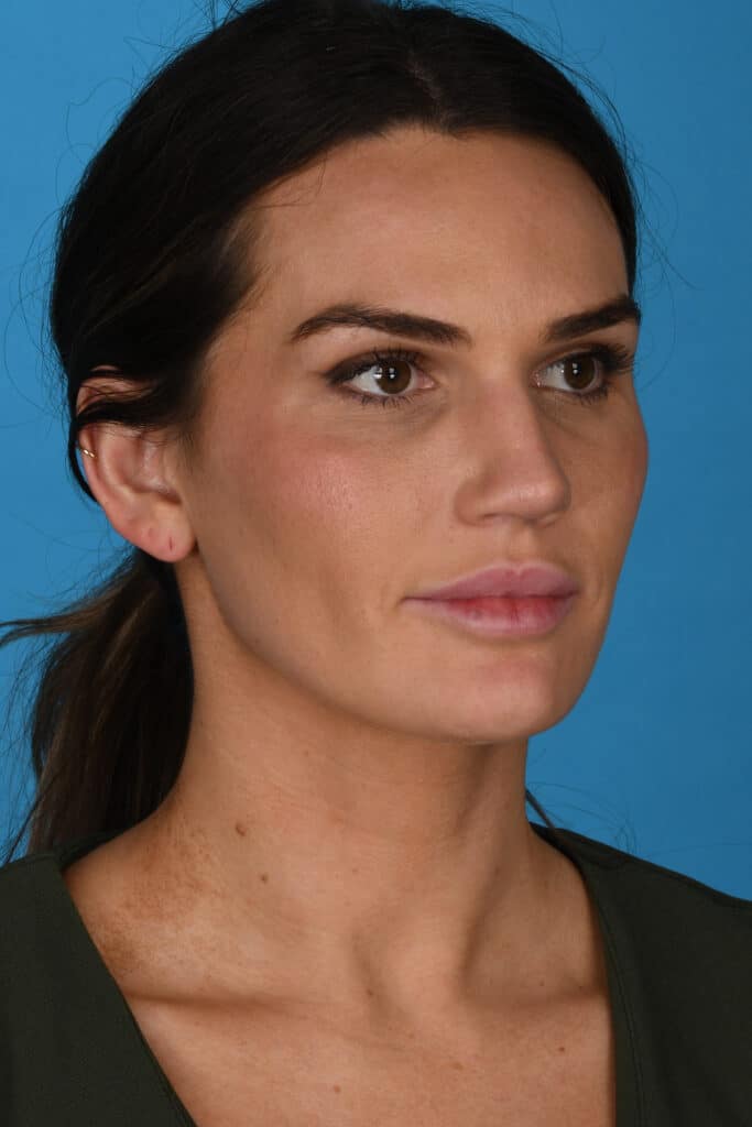 After Image: Rhinoplasty - right-front-oblique