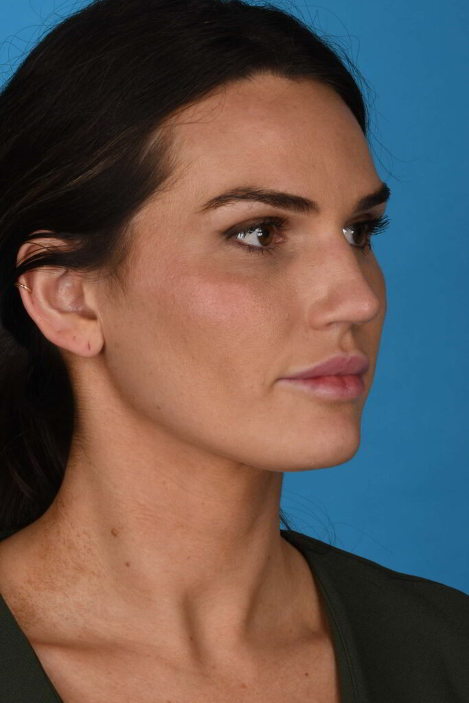 After Image: Rhinoplasty - right-front-oblique