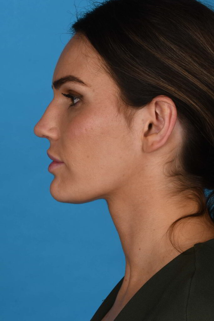 After Image: Rhinoplasty - left-side