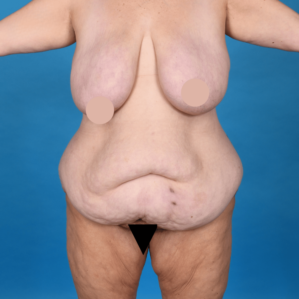 Before Image: Circumferential abdominoplasty, bilateral breast reduction, liposuction 360 - left-front-oblique