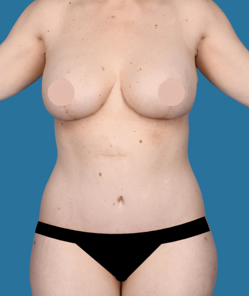 After Image: Extended abdominoplasty, liposuction 360 - front