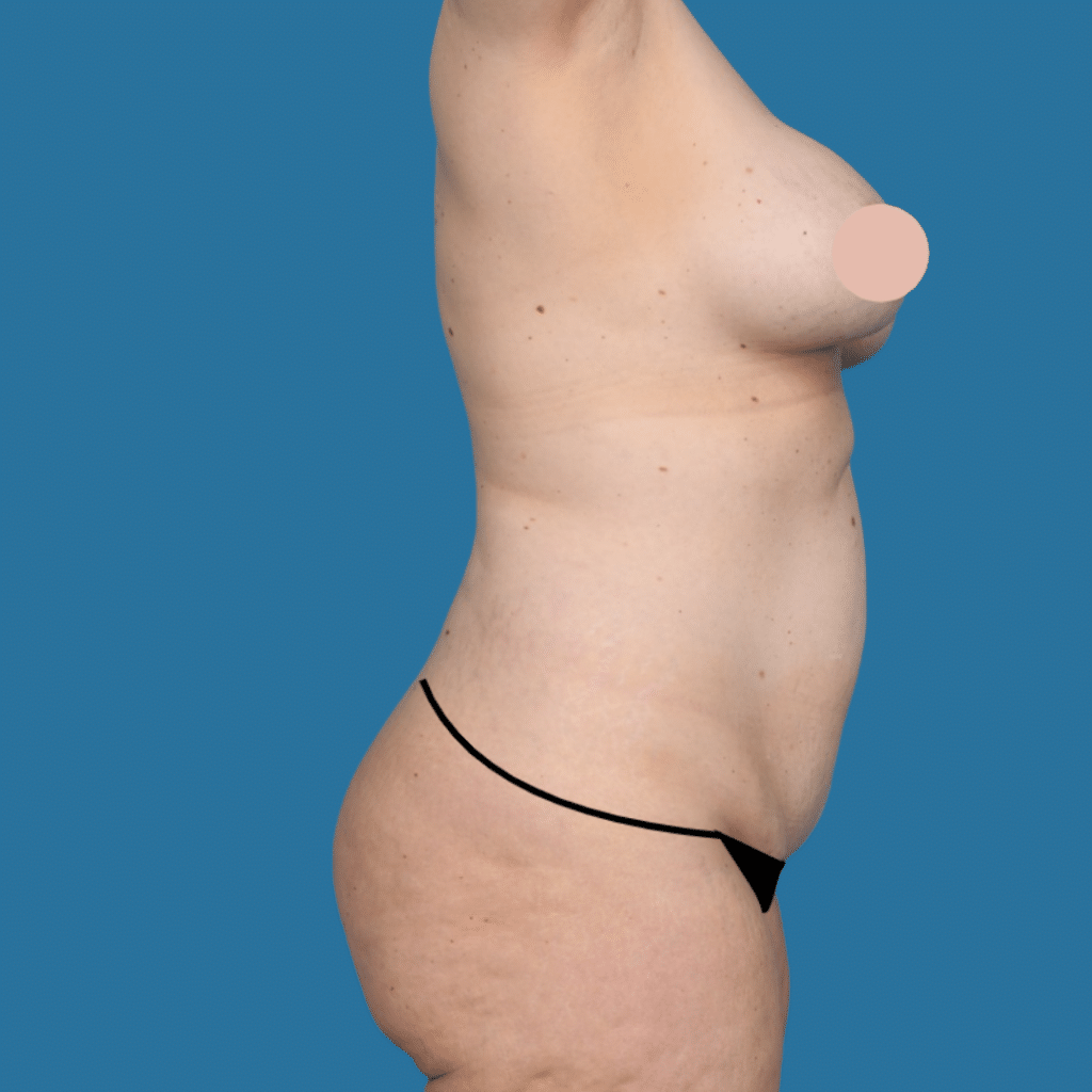 Before Image: Extended abdominoplasty, liposuction 360 - right-side