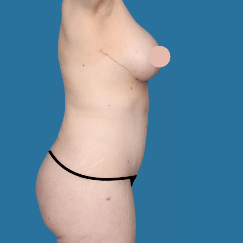 After Image: Extended abdominoplasty, liposuction 360 - right-side