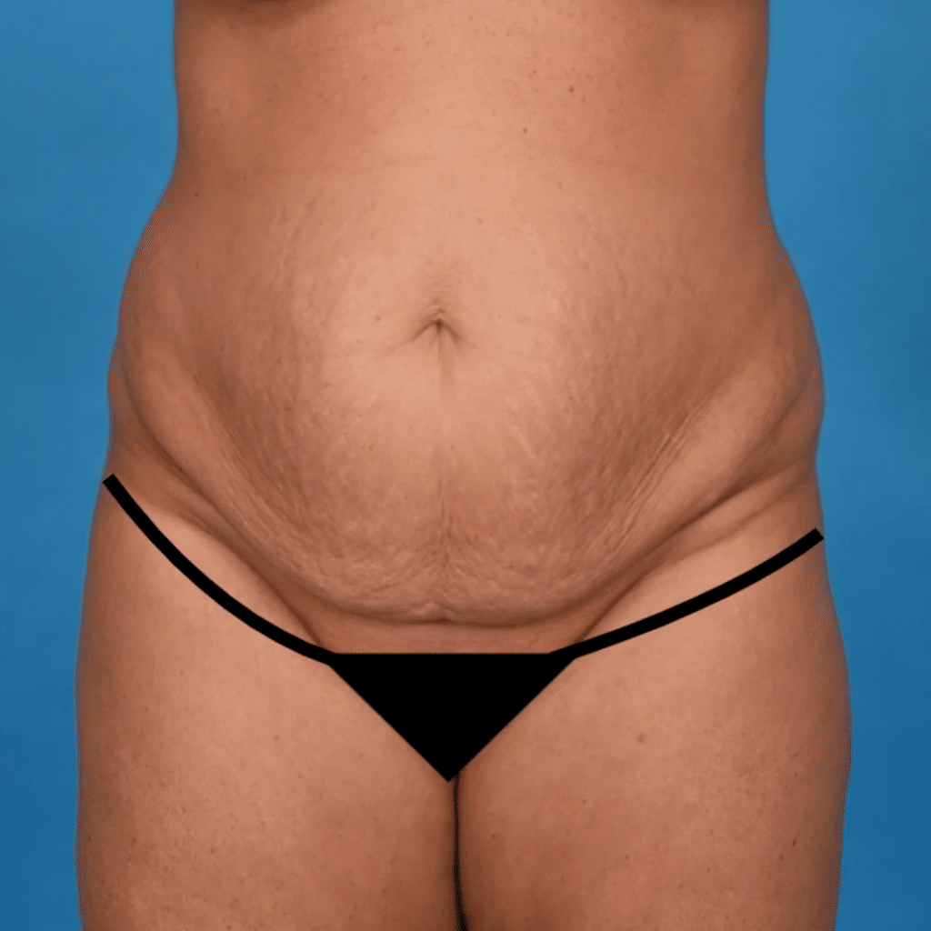 Before Image: Extended abdominoplasty, liposuction 360 - front