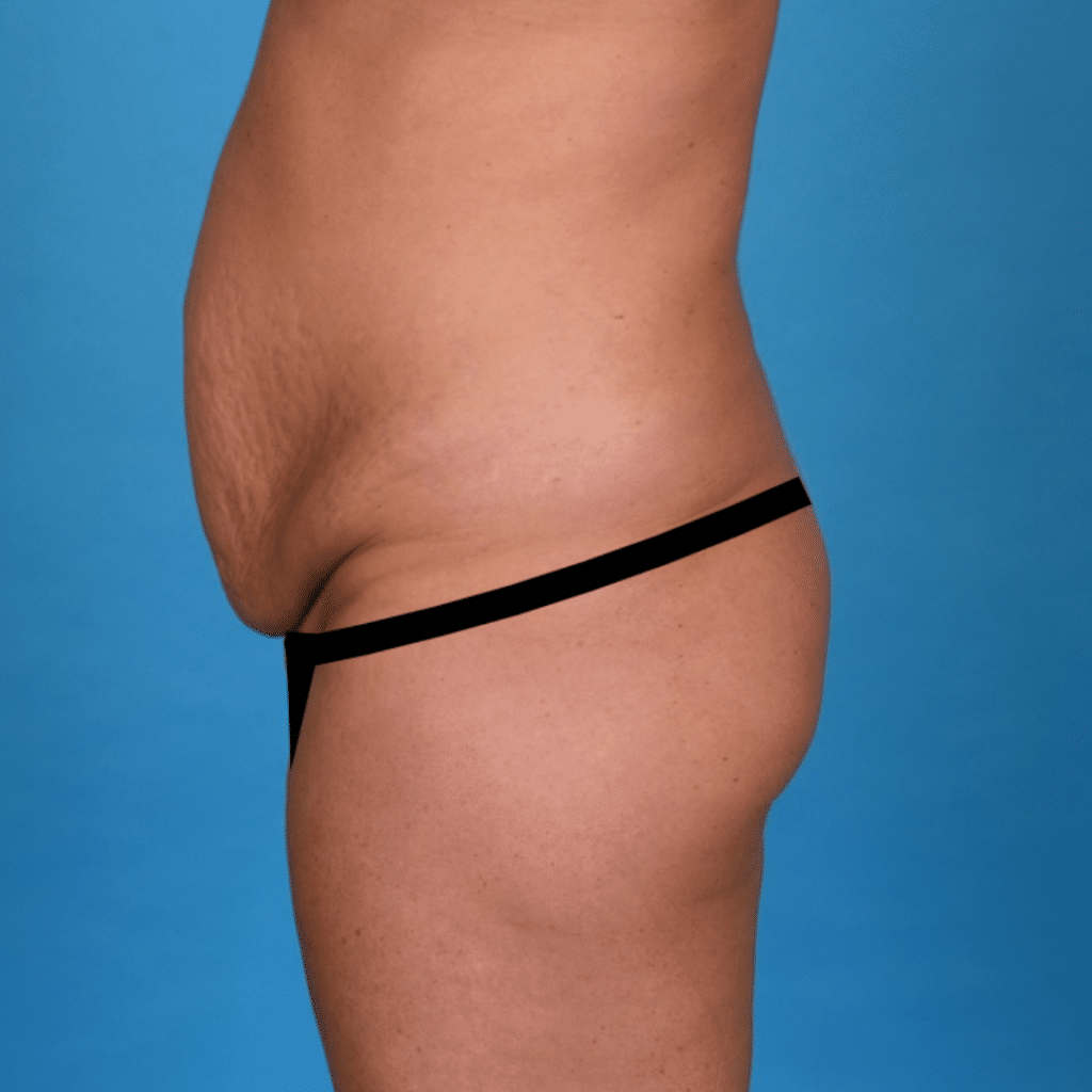 Before Image: Extended abdominoplasty, liposuction 360 - left-side