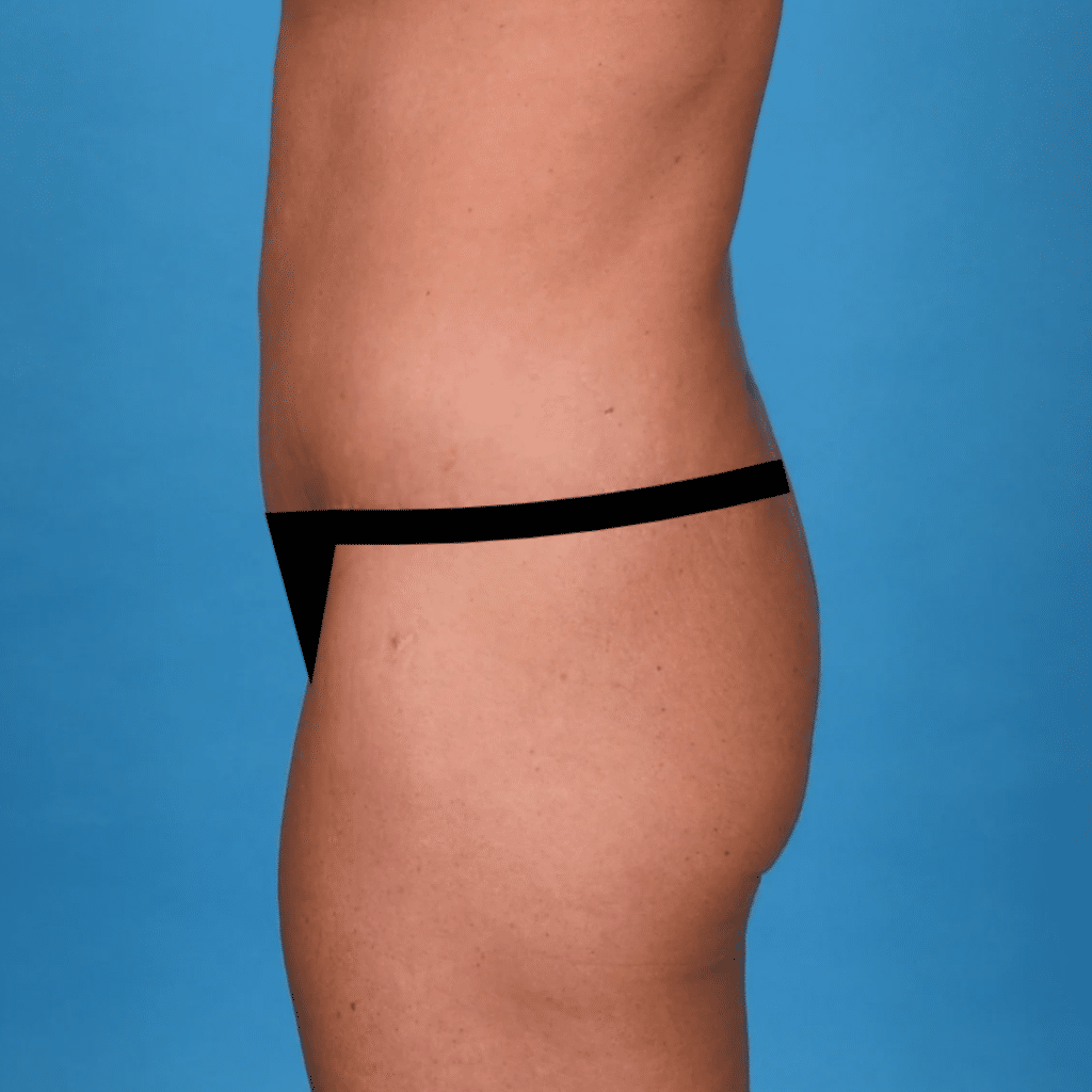 After Image: Extended abdominoplasty, liposuction 360 - left-side