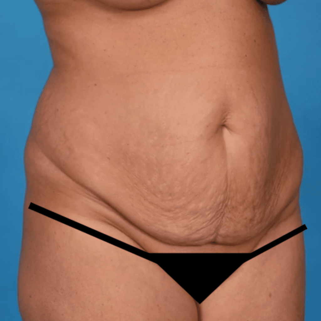 Before Image: Extended abdominoplasty, liposuction 360 - right-front-oblique