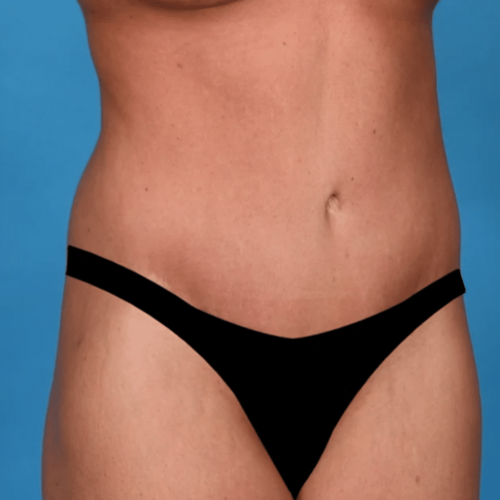 After Image: Extended abdominoplasty, liposuction 360 - right-front-oblique